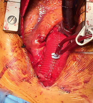 Chirurgie de l’aorte et de l’arche Aortique